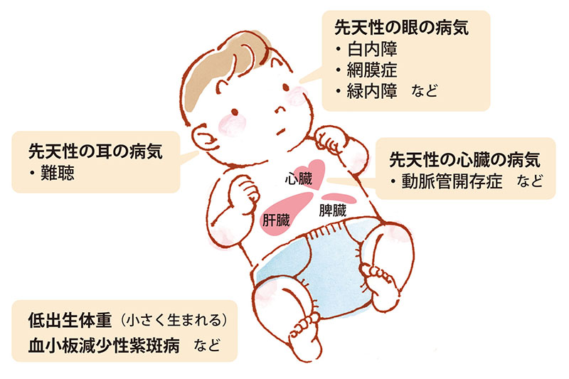 先天性風しん症候群の赤ちゃんに見られる主な症状：目・耳・心臓の先天性の病気、低出生体重、血小板減少性紫斑病など